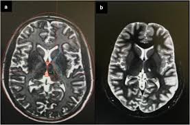 Image result for Thalamotomy