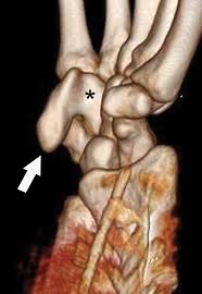 Image result for Hamate Bone