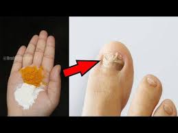 Fungal Nail Infection Treatment Simple Home Remedy To Get Rid Of Toenail Fungu In 2020 Nail Infection Treatment Fungal Nail Infection Treatment Fungal Nail Infection