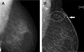 Image result for Mammogram Interpretation