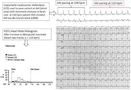 Image result for Bundle Branch Block