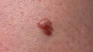 See before and after photos of patients who have undergone reconstructive plastic surgery after skin cancer removal (mohs surgery). Melanoma Blood Test Scientists Unveil World First Research Bbc News
