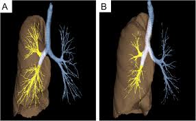 They are lined with mucus that traps everything from mould spores to flies. Associations Of Airway Tree To Lung Volume Ratio On Computed Tomography With Lung Function And Symptoms In Chronic Obstructive Pulmonary Disease Respiratory Research Full Text