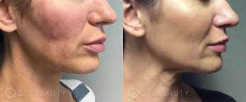 Skin Care & Chemical Peels Treatment