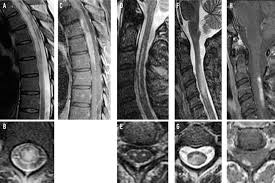 Consult a doctor for medical advice. Frequency Of Aquaporin 4 Immunoglobulin G In Longitudinally Extensive Transverse Myelitis With Antiphospholipid Antibodies Mayo Clinic Proceedings