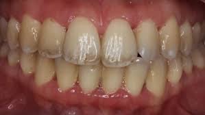 Découvrez le traitement naturel recommandé par ma dentiste énergéticienne et qui a très bien marché sur moi : Gingivite Traitement Cabinet Parodontie Paris 11 Docteur Chevalier