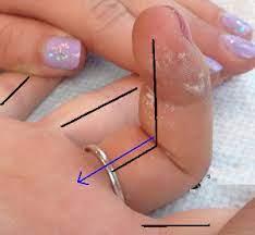 Regarding this, how do you test fdp and fds? Flexor Tendon Injury Orthopaedia