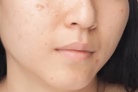 Aduhai, cubalah 5 cara hilangkan muka berminyak yang dikongsikan ini. 4 Cara Menghilangkan Bekas Luka Di Wajah Hello Sehat