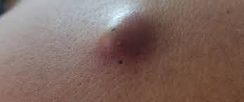 الكيس الدهني أسباب وأعراض وعلاج ويب طب