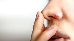 Herpes Eine Potenziell Todliche Erkrankung Wissen Stuttgarter Nachrichten
