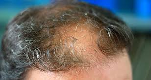 This is the electric rake info i've been promising. How Can Prp Help With My Hair Loss By Stimulating Hair Growth Associates In Dermatology