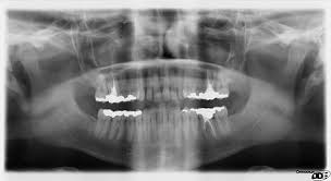 dental radiography wikipedia