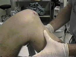 Image result for PCL Sulcus Test