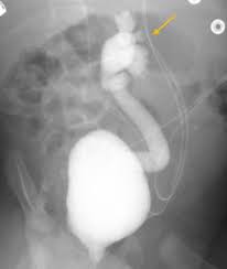 Image result for Voiding Cystourethrogram