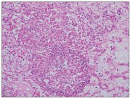 Start studying granulomatous and specific inflammation (l8). Sarcoid Like Granulomatous Reaction In Renal Cell Carcinoma Report Of A Case With Review Of The Published Reports Annals Of Saudi Medicine