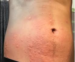 Image result for sweat rash on back