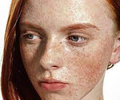Rutilism Or Red Hair Red Hair Freckles Getting Rid Of Freckles Freckles Girl