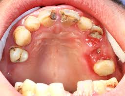 Image result for dental cancer