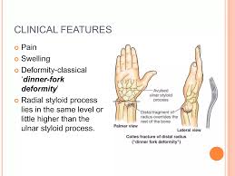 Image result for Fall on Outstretched Hand