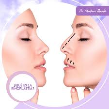 La Rinoplastia es una cirugía que se realiza con la finalidad de reparar o  remodelar los defectos propios de la nariz. Su objetivo principal en  términos estéticos es buscar una armonía facial.
