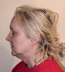 Any reviews for Dr Israel espino? Looking for a deep plane face lift with  minimal scarring. Thank you