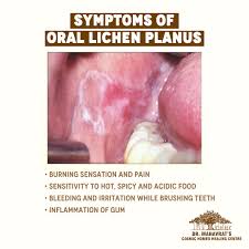 Oral Lichen Planus Treatment Homeopathy