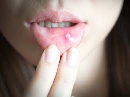 The doctor used stitches to close the cut. 10 Natural Home Remedies To Get Rid Of Mouth Ulcers The Times Of India
