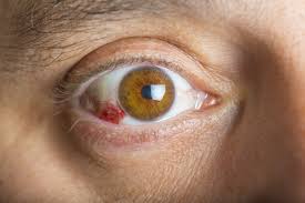 Image result for Conjunctivitis