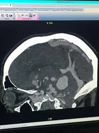 Dural Arteriovenous Fistula Persistent Falcine Sinus Too Radiology Nuclear Medicine Surgery Recovery