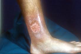 Image result for Pyoderma Gangrenosum