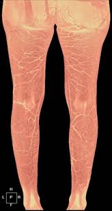 This webpage presents the anatomical structures found on thigh mri. Unusual Causes Of Varicose Veins In The Lower Extremities Ct Venographic And Doppler Us Findings Radiographics