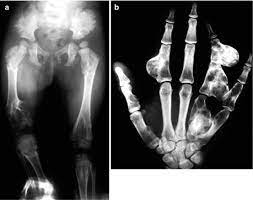 Multiple Chondromas Chondromatosis Ollier S Disease Associated Condition Maffucci S Syndrome Radiology Key