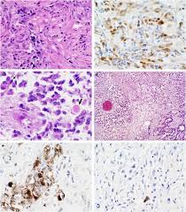 This is the newest place to search, delivering top results from across the web. Malignant Mesothelioma With Heterologous Elements Clinicopathological Correlation Of 27 Cases And Literature Review Modern Pathology