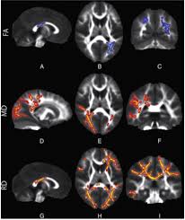 Breakthrough Study Reveals Biological Basis For Sensory Processing Disorders In Kids Sensory Processing Disorder Sensory Processing Processing Disorder
