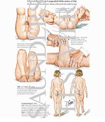 Image result for Galeazzi Sign