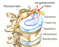 Lernen sie die übersetzung für 'gallertkern' in leos polnisch ⇔ deutsch wörterbuch. Die Wirbelsaule Aufbau Funktion Erkrankungen Der Wirbelsaule