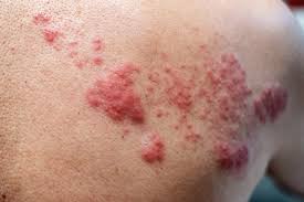 Image result for skin rash acute hiv infection