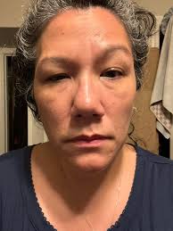 Any natural remedies for eye circles and dizziness?