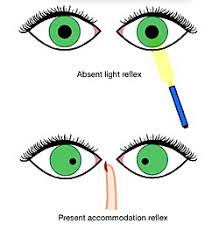 Image result for Neurosyphilis