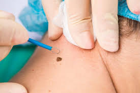 Comment choisir un dermatologue pour mon problème de peau ? Grains De Beaute Les Medecins Deconseillent De Les Enlever Au Laser