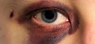 To help strengthen your body's response to bruising and cut down the healing. How To Make Black Eyes Bruises Hickeys Fade Heal Faster In 5 Different Ways Home Remedies Wonderhowto