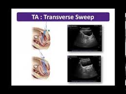 Female pelvis ultrasound protocol the patient should be scanned either trans abdominally (ta) with a full bladder or trans vaginally (tv). Basic Applications Female Pelvis Scanning Techniques Youtube