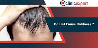 Experts at the mayo clinic state, the most common cause of hair loss is a hereditary condition that happens with aging. Do Hats Cause Hair Loss Clinicexpert International Hair Transplant Plastic Surgery