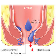 Image result for hemoroid human