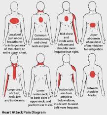 Profile view of female chest area. Physioosteobook Heart Attack Pain Diagram Facebook