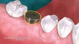 Maybe you would like to learn more about one of these? Post Dental Implant Care Instructions Dental Implant Aftercare