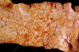 Image result for Cardiovascular Syphilis