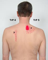 Trapezius Trigger Point Referral Patterns