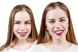 Invisalign treatment costs vary based on a provider's experience. Monthly Payment Plans For Dental Braces Without Insurance