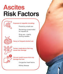 Ascites risk factors infographic with distended abdomen and list of liver-related risk factors